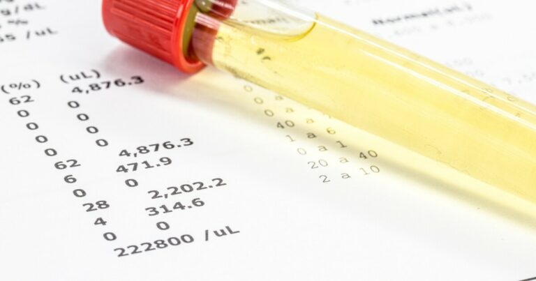 Jednoduchý test moči navržený jako časný diagnostický nástroj pro Alzheimerovu chorobu