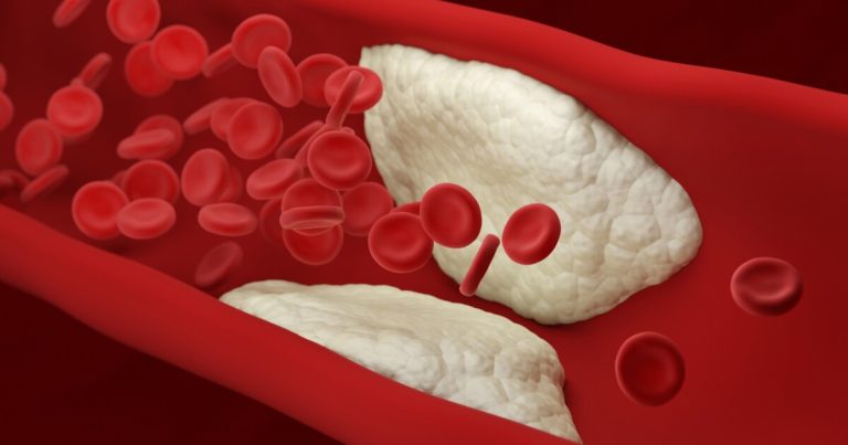 Ukazovat pacientům jejich obrázky plaku je nutí řešit srdeční rizika